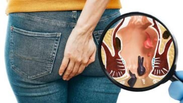 Co to są hemoroidy (żylaki odbytu) i jak je leczyć?