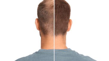 Przeszczep włosów FUE: Cena, Procedura i Oczekiwania