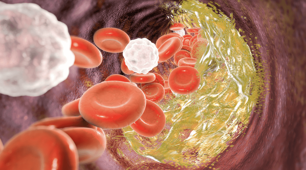 Wysoki cholesterol - co jeść? Tabela produktów pomocnych w obniżeniu cholesterolu