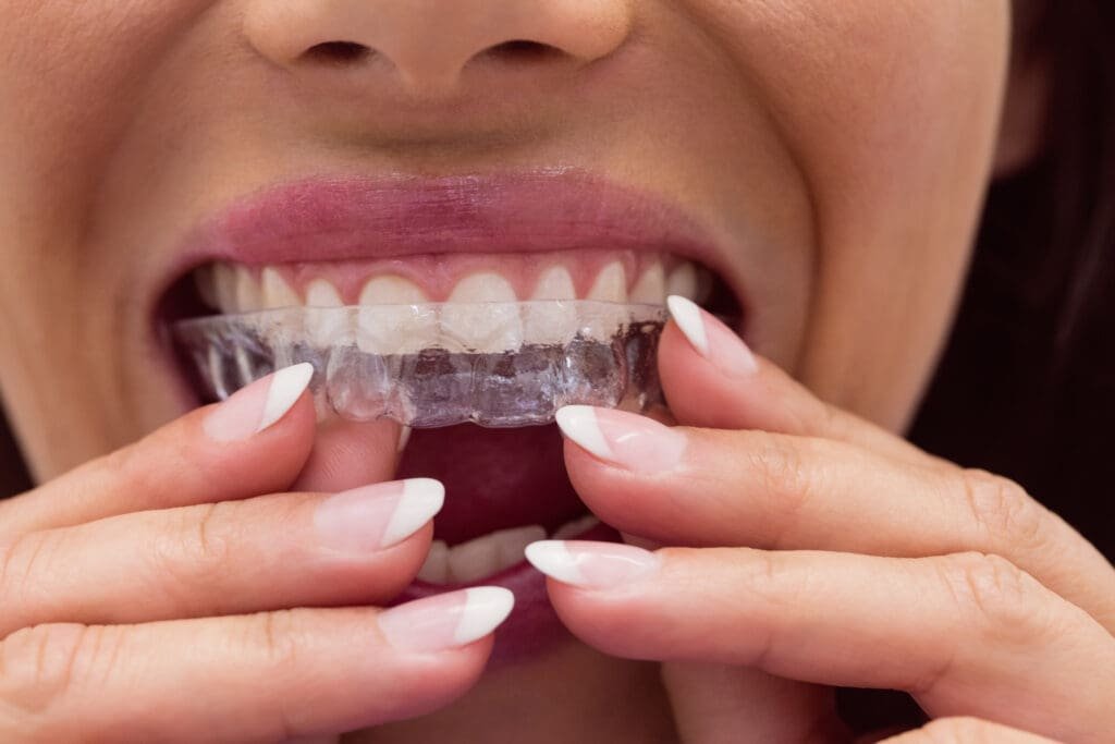 Czy ortodoncja invisalign to rozwiązanie dla Ciebie? Sprawdź, zanim założysz aparat Czy ortodoncja invisalign to rozwiązanie dla Ciebie? Sprawdź, zanim założysz aparat